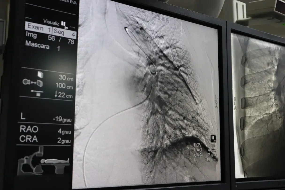 HGG passa a ser único hospital público a realizar angioplastia pulmonar por balão em Goiás