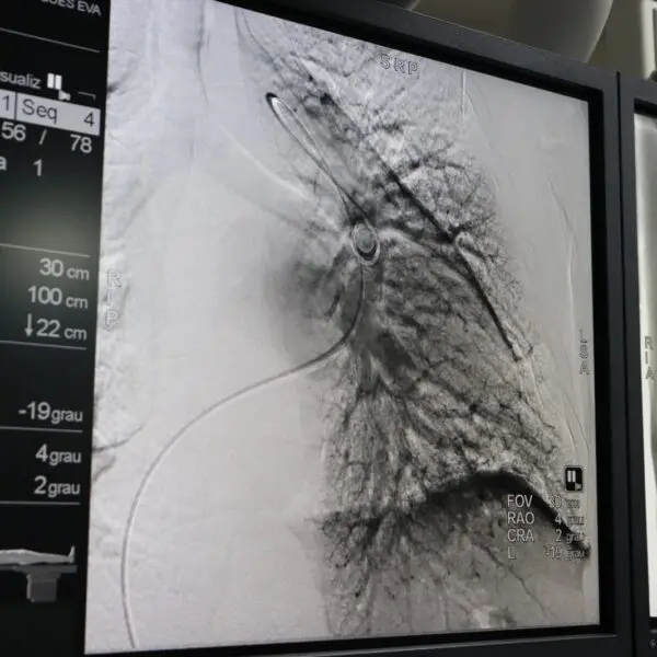 HGG passa a ser único hospital público a realizar angioplastia pulmonar por balão em Goiás