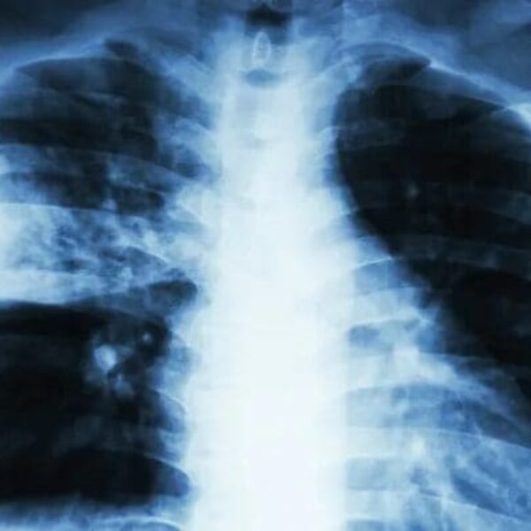 HDT orienta sobre pneumonia silenciosa