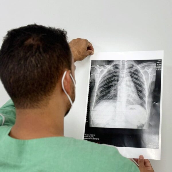 Agosto Branco: Saúde alerta sobre riscos do câncer de pulmão