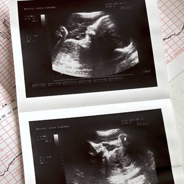 Mutirão de ecocardiogramas fetais do Hospital Estadual da Mulher realiza 78 exames - mutirão de ecocardiograma fetal