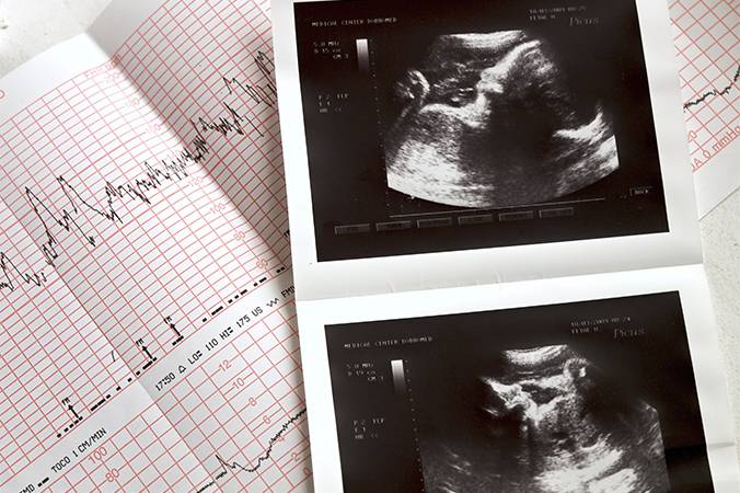 Hemu realiza mutirão de ecocardiograma fetal